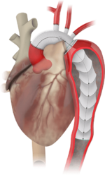 TERUMO AORTIC THORAFLEX HYBRID product image