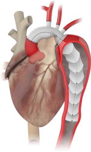 TERUMO AORTIC THORAFLEX HYBRID product image 1