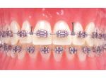 G&H Orthodontics Acél product image