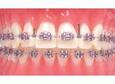 G&H Orthodontics Acél product image