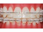 Ortho Technology Zafir bracket PURE product image 2
